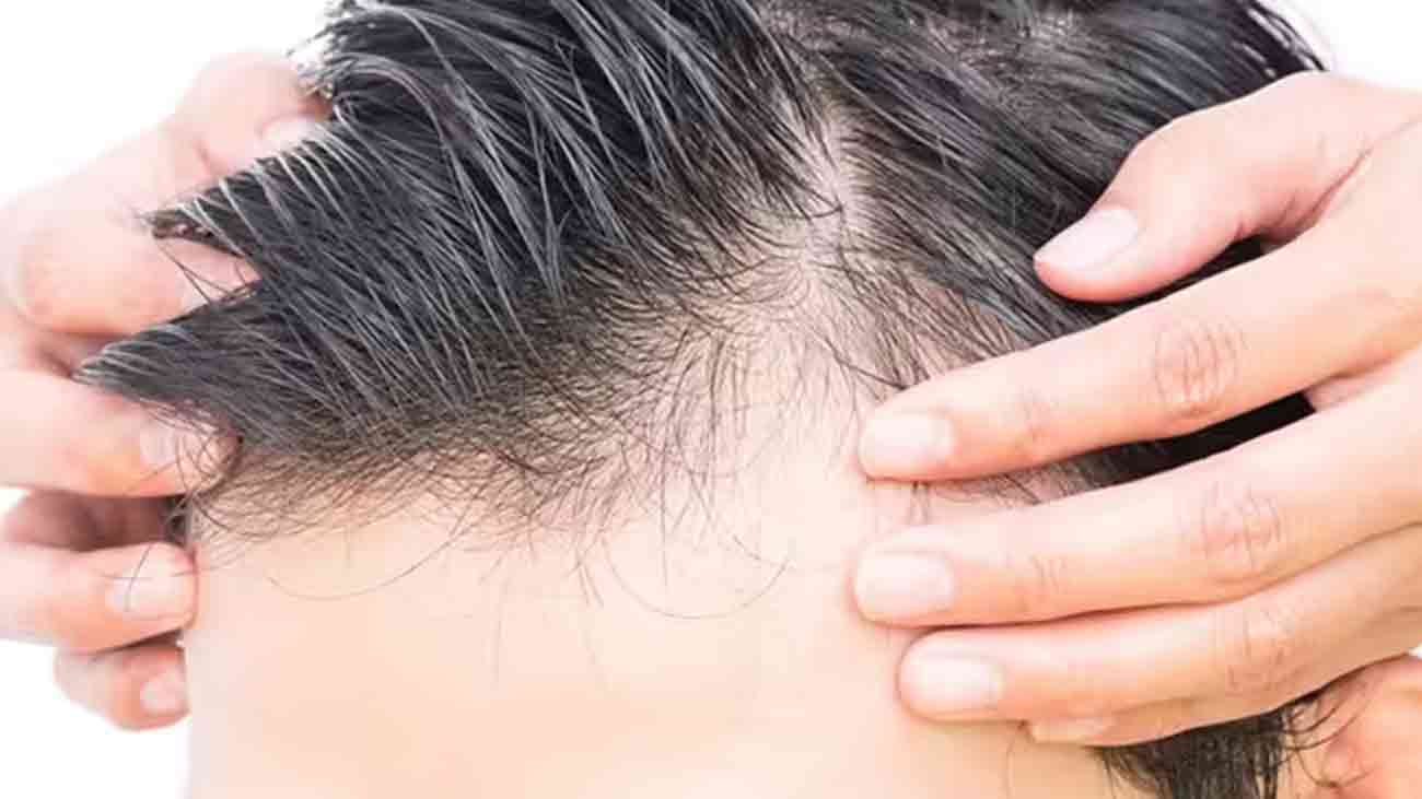 بال گرنے سے پریشان؟جانیں اس سے بچاؤ کے آسان طریقے