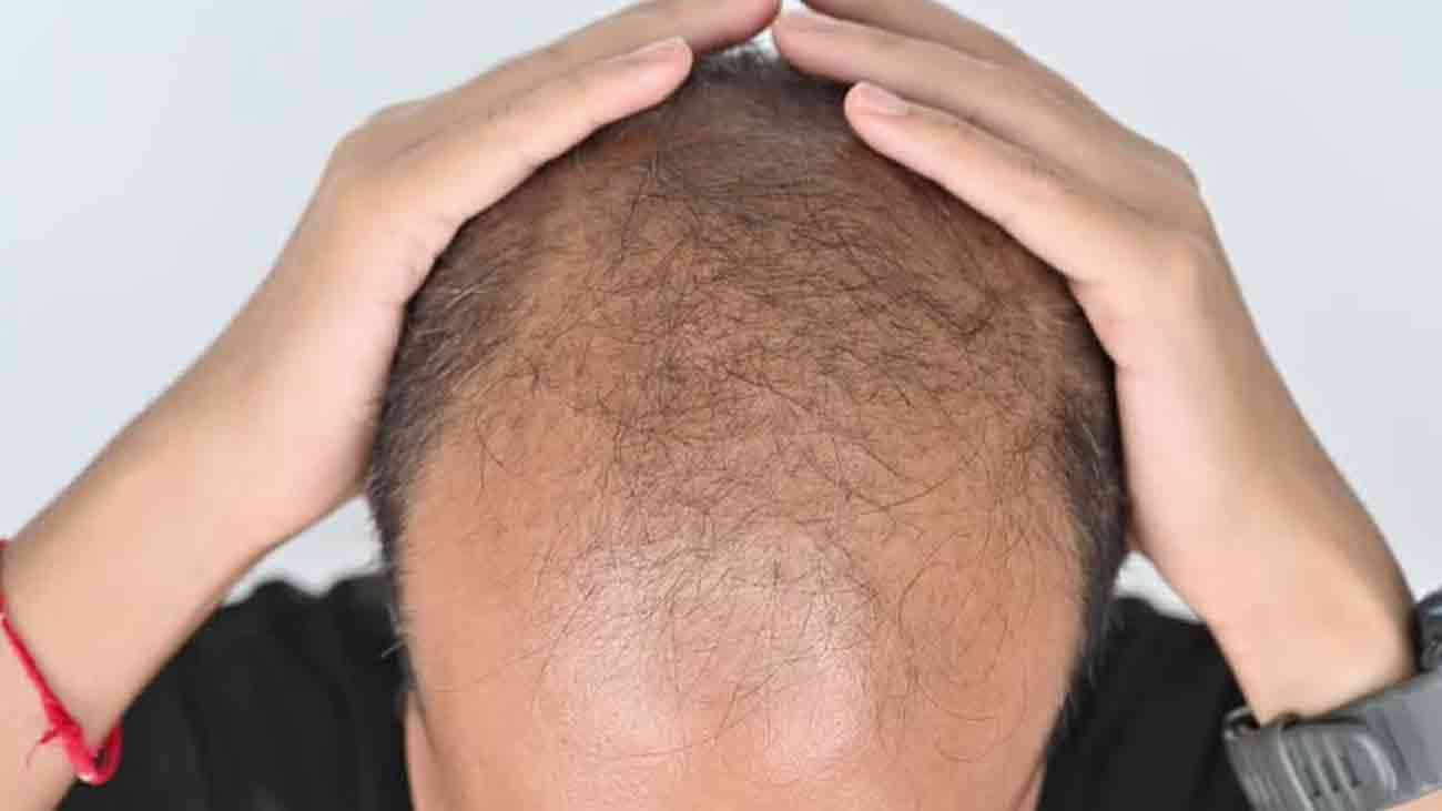 سائنسدان گنجا پن کا علاج دریافت کرنے میں کامیاب baldness treatment