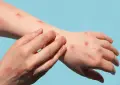 لاہور میں منکی پاکس کے کیسز میں اضافہ