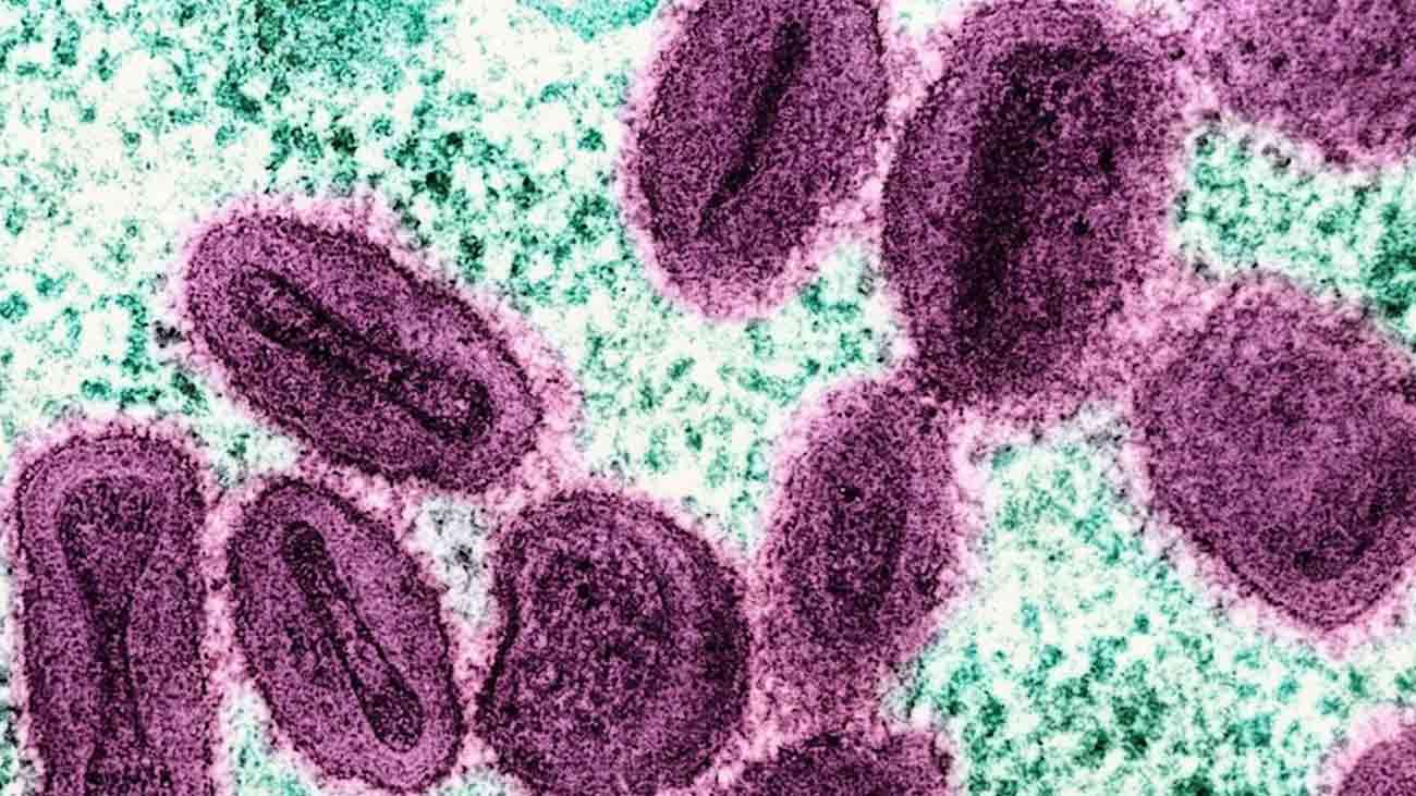 Mpox Case Karachi