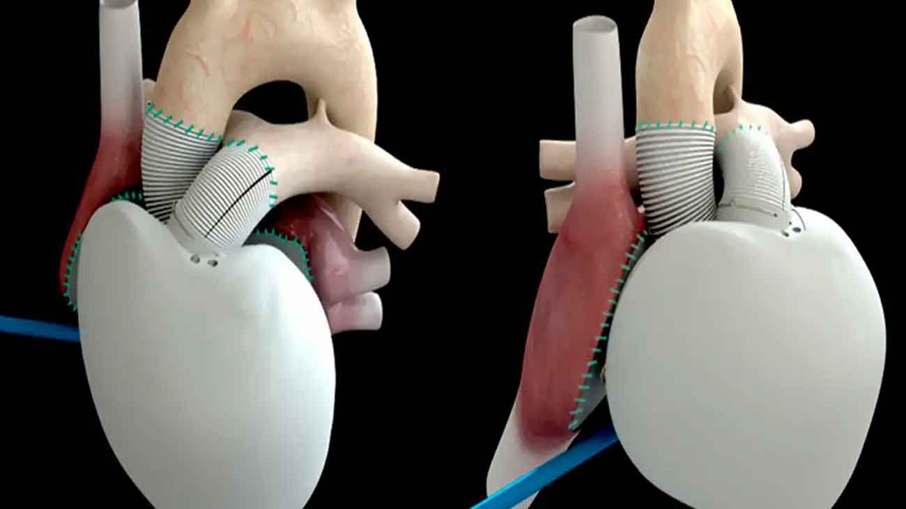 artificial heart transplant