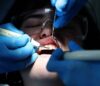دانت کے کیڑے کا غلط علاج،ڈینٹسٹ کو 42 لاکھ روپے جرمانہ